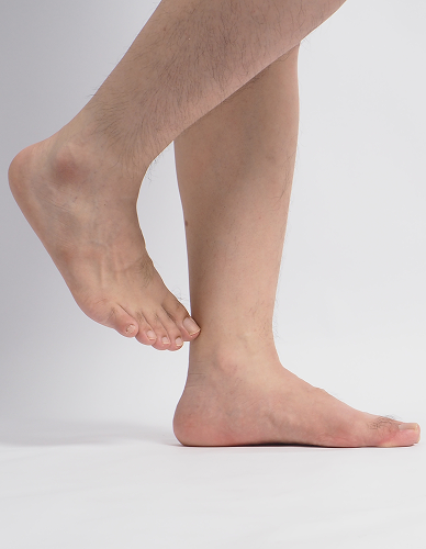 Flat Feet